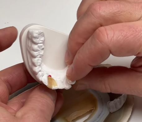 Using IPS e.max Press With A Maryland Bridge